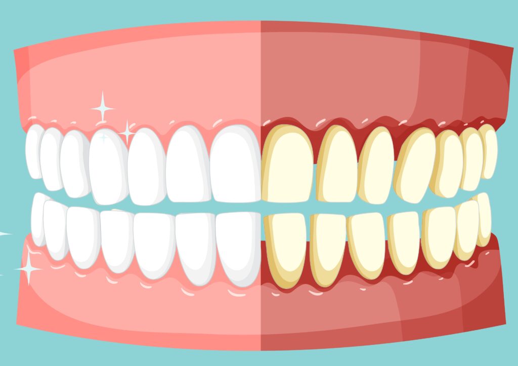 periodontitis