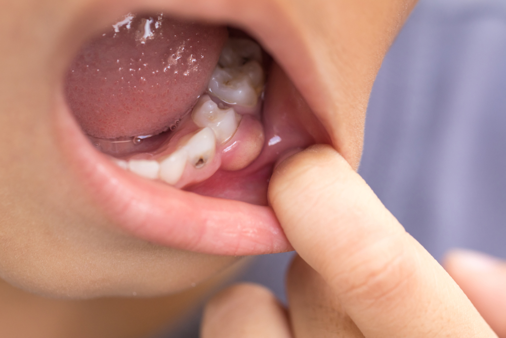 tooth cavity | Kids Dental Problems and Solutions